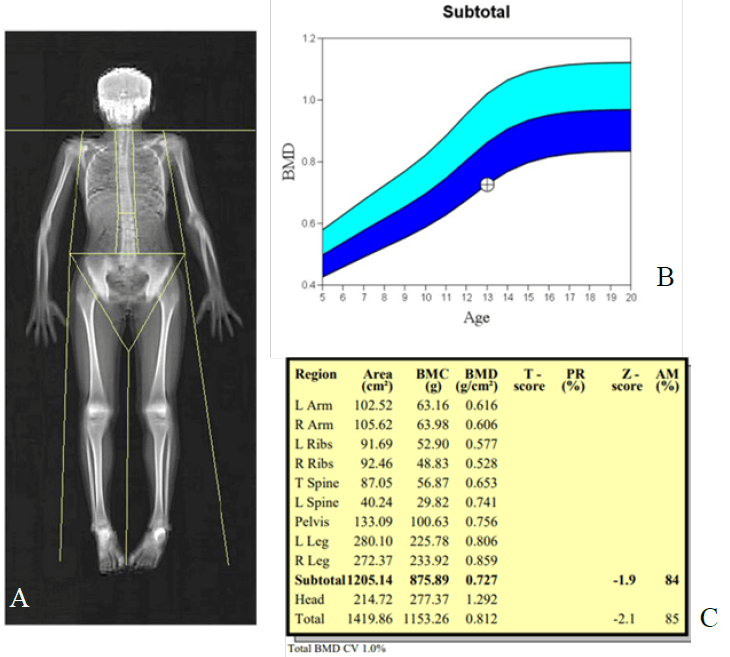 Figura 1. Imagen la densitometría ósea (A), gráfico de Z-score (B) y tabla de resumen (C) correspondientes a la edad y el sexo de la densidad de masa ósea. El Z-score de la densidad de masa ósea se derivó de la base de datos normativa del Estudio de la Infancia para niños de 5 a 23 años (1).